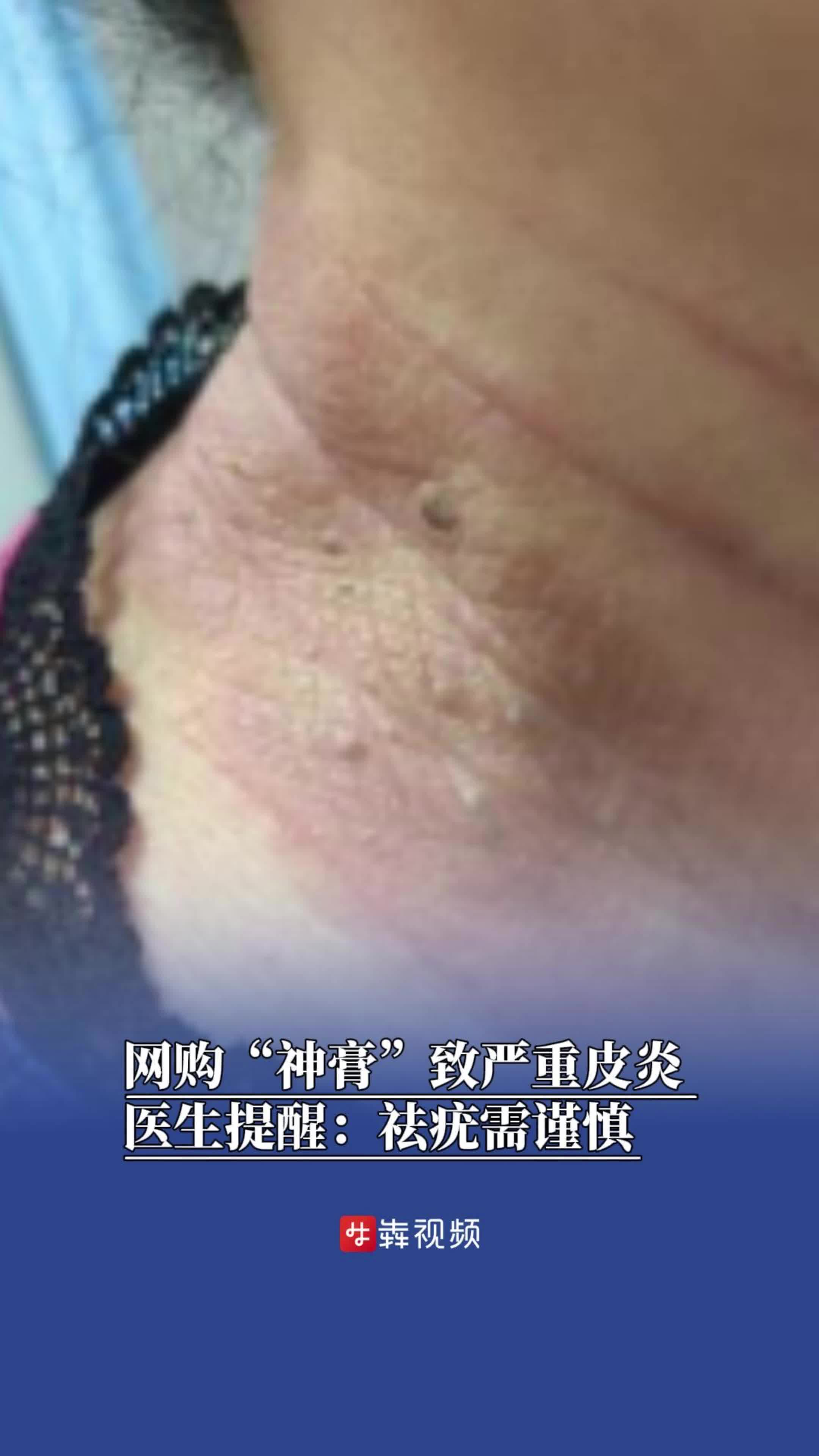 網(wǎng)購(gòu)“神藥”導(dǎo)致嚴(yán)重皮炎，醫(yī)生提醒：祛疣需謹(jǐn)慎