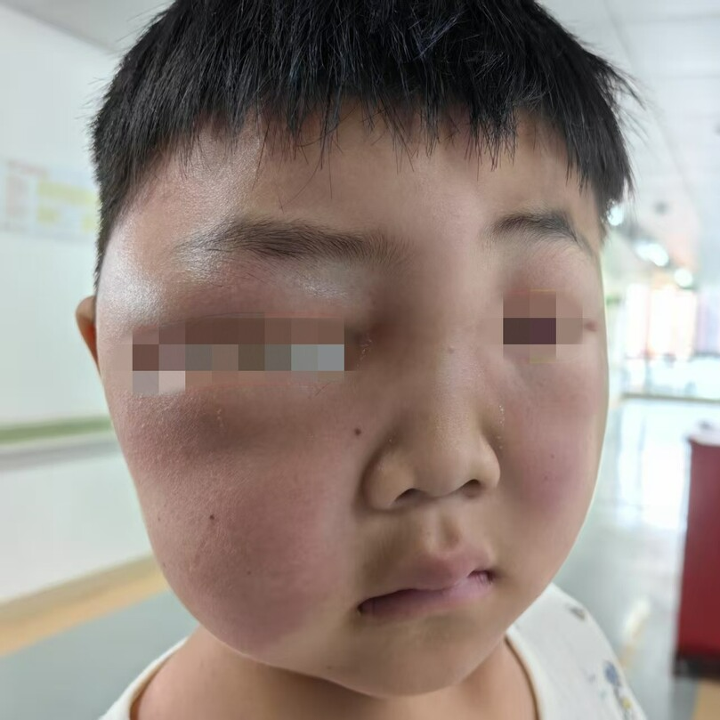 小心夏虫！虫咬性皮炎高发季来了，4岁男孩被叮成“猪猪侠”