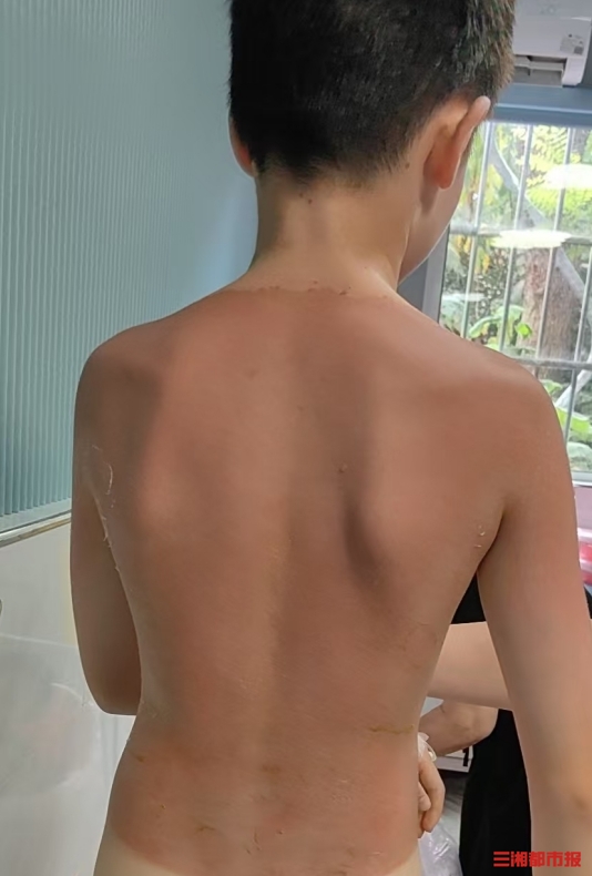 11歲男童旅游后突發(fā)水皰高燒，暑假曬傷的孩子激增