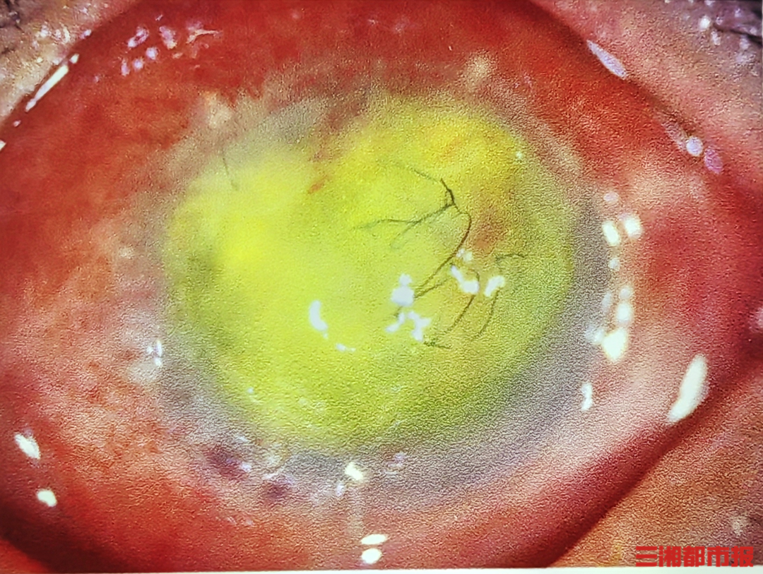 秋收忙，护眼要跟上，农忙期眼外伤防护指南来了