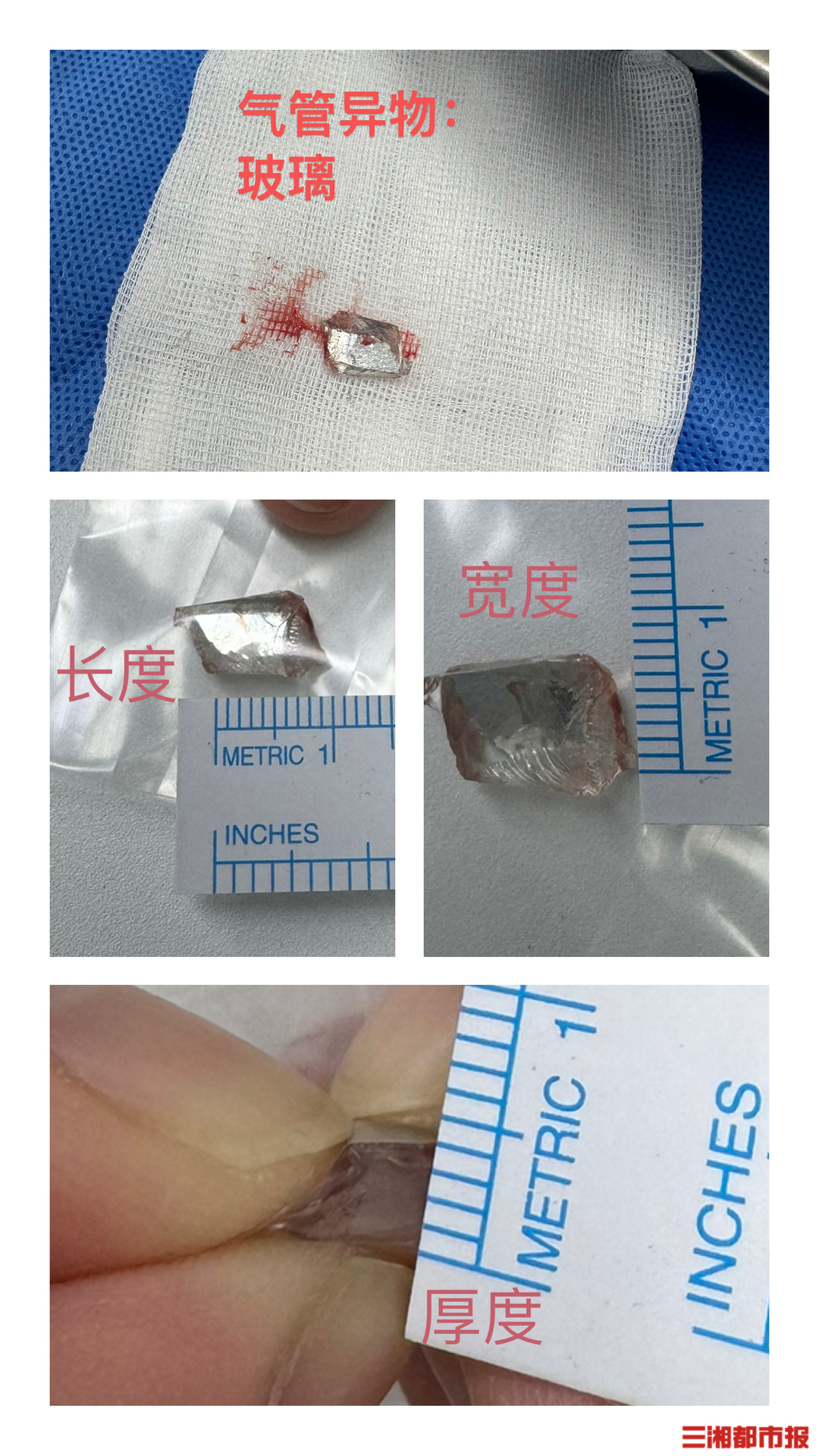 1岁宝宝误吞1厘米长玻璃渣，岳阳长沙紧急联动救援脱险