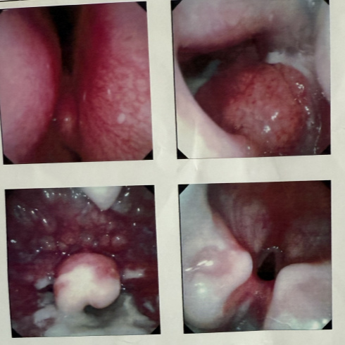 流感季用热气熏蒸喉咙治咳嗽，6岁女童被烫伤