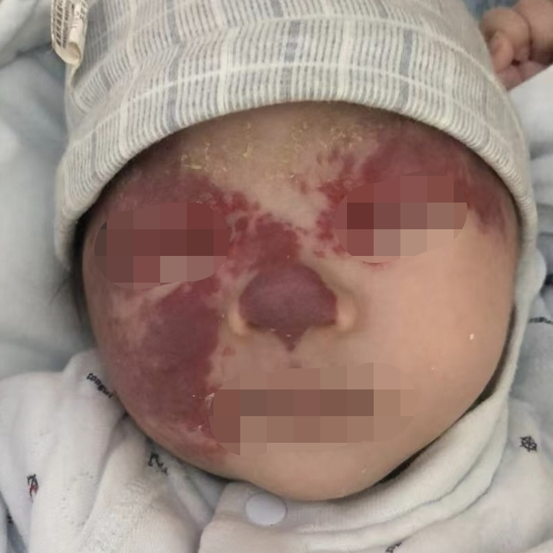 女宝红色胎记长满脸，医生治疗5年成功消除