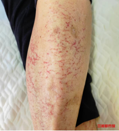 烤火皮肤烤出“蛇纹”，冬季取暖警惕“火激红斑”